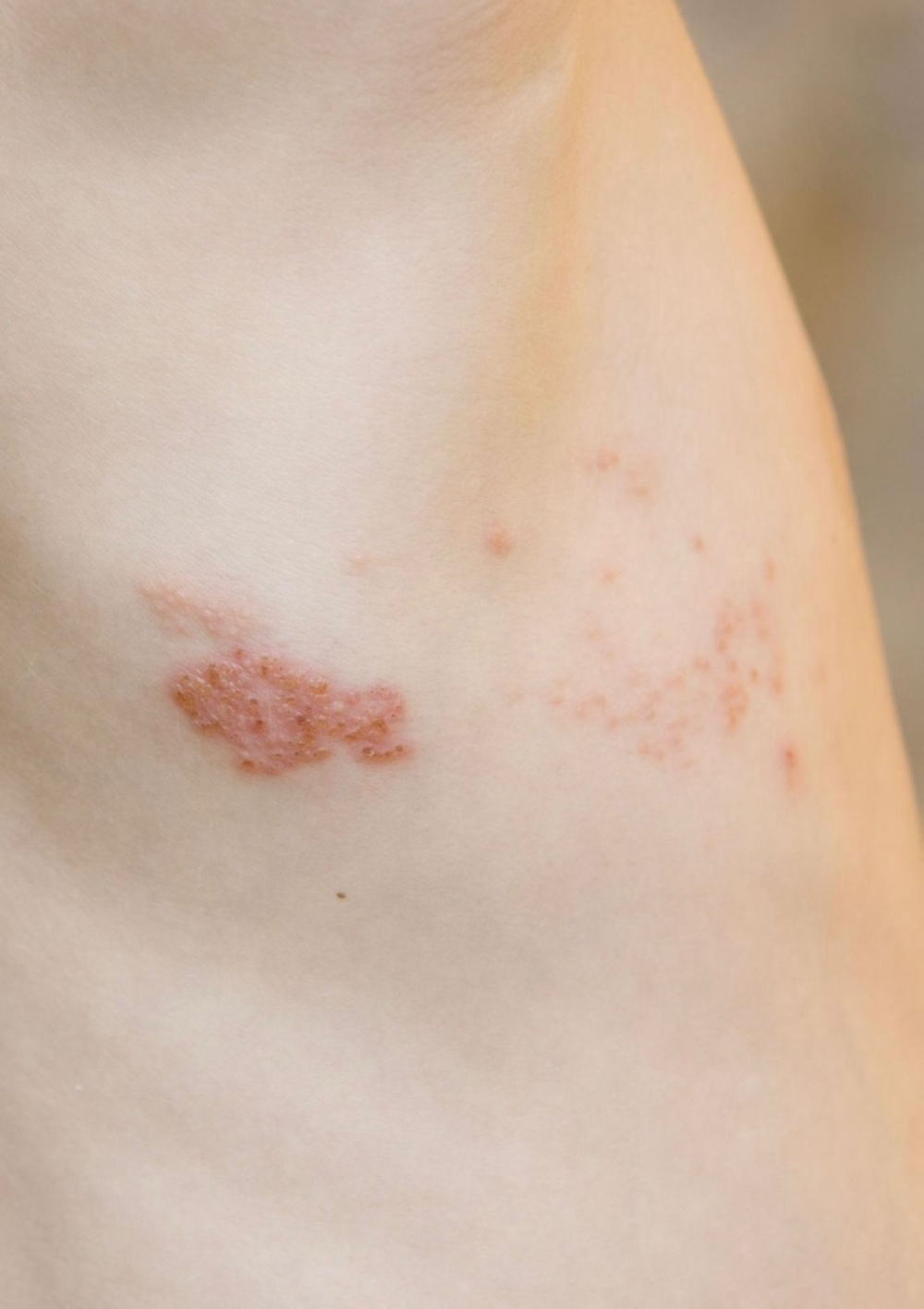 قصة الحزام الناري تبدأ بوخز وتنتهي بمعاناة طويلة 